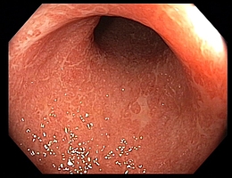 Endoskopie - Morbus Crohn