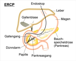 Endoskopische Retrograde Cholangio-Pankreatikographie (ERCP)