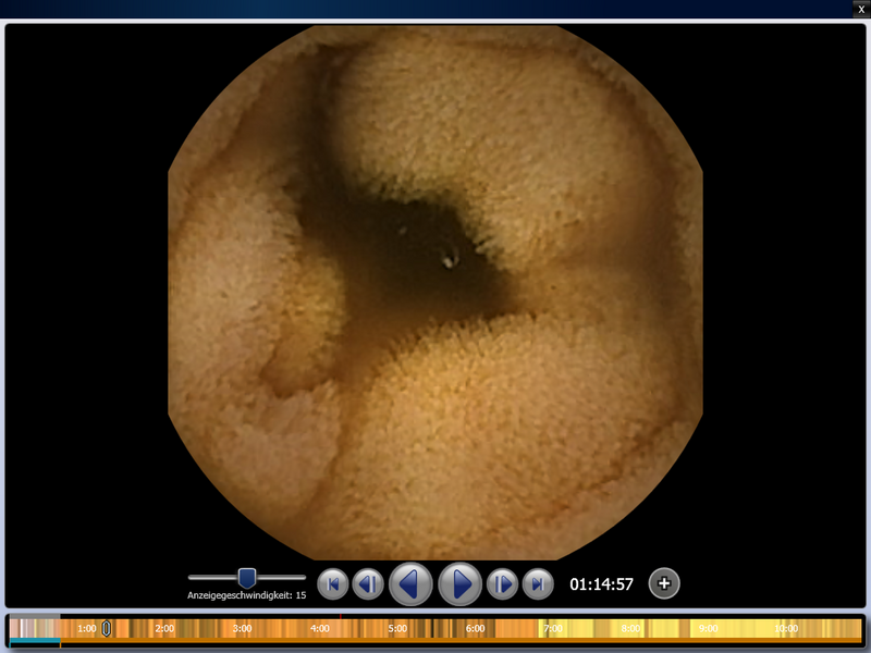 Bild einer Kapsel mittels Endoskopie, magenspiegelung rostock