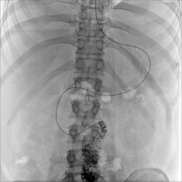 Röntgenbild vom Brustkorb mit Endoskop